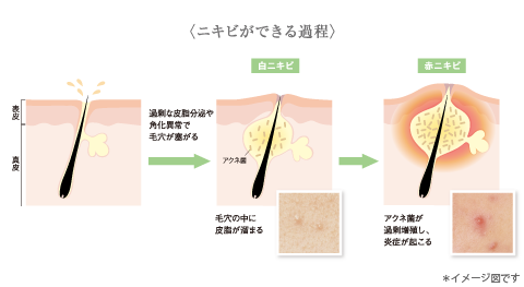 ニキビができる過程