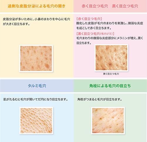 過剰な皮脂分泌による毛穴の開き／赤く目立つ毛穴／タルミ毛穴／角栓による毛穴の目立ち